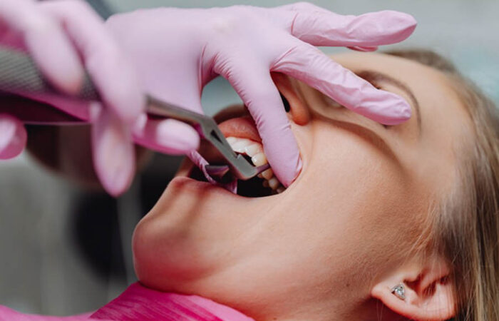 Wisdom Tooth Extraction