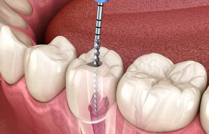 Root Canal Treatment